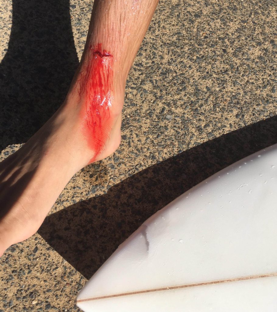 Adamovo další surfařské zranění